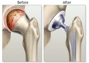 total-hip-replacement